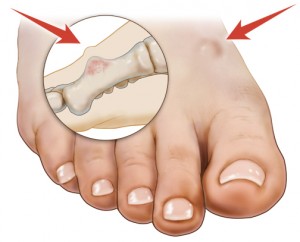 Bone Tumor Of The Foot