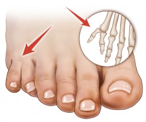 Polydactyly of the Feet