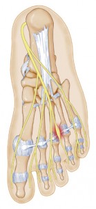 foot neuroma