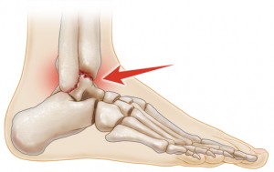 Arthritis in Feet