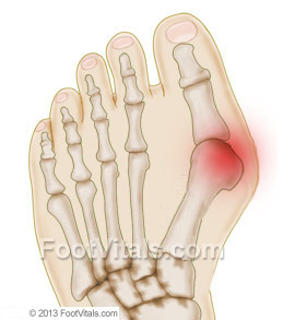 Large picture of foot bunion